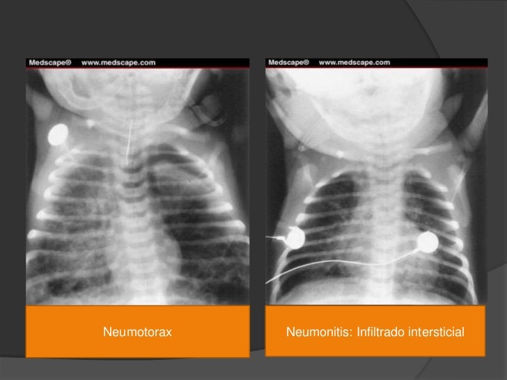 Sindrome De Aspiraci n Meconial Sam Sindrome De Aspiraci n Meconial Sam