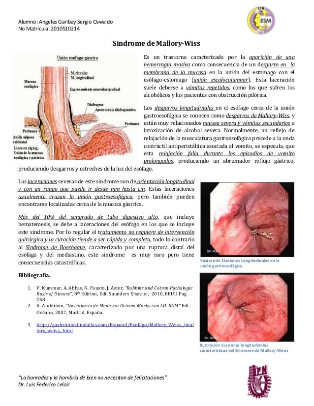 Sindrome de Mallory Weiss