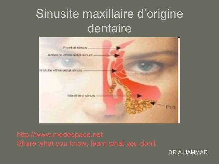 comment traiter une sinusite maxillaire