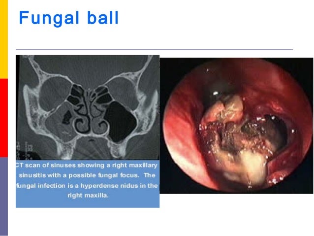 sinus congestion and terrible headache clean sinuses pinch nose