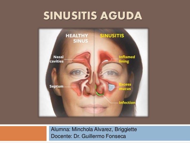 sinus balloon surgery publish op