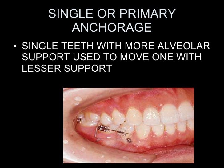 anchorage in orthodontics