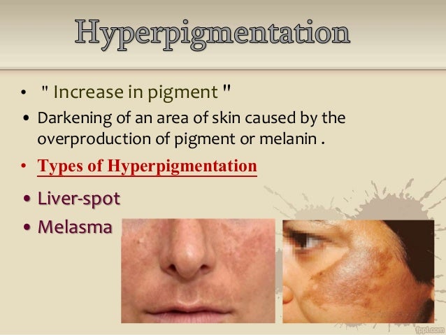 Skin Pigmentation Disorders | Hyperpigmentation | MedlinePlus