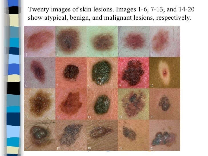 skin cancers pictures early stages #10