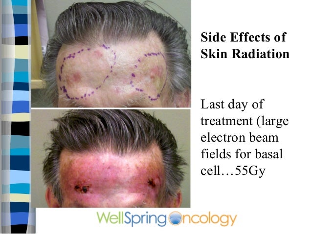 Imuran Side Effects Skin Cancer