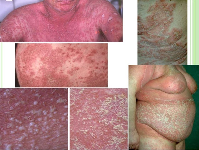 Kidney sickness Early symptoms