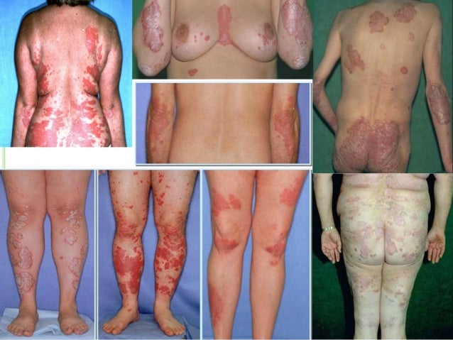 Scalp Psoriasis - Causes, Symptoms, Treatment, Pictures ...