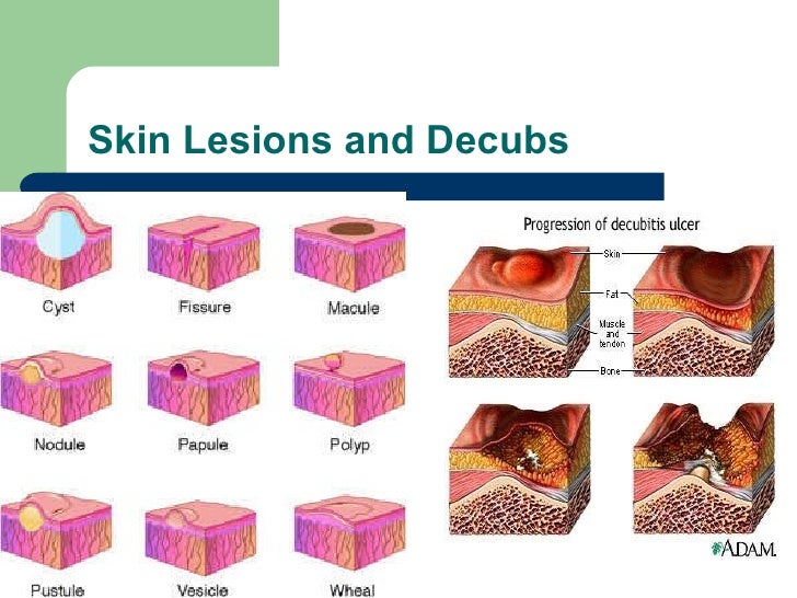 Skin Lesions – Causes, Pictures, Types, Symptoms, Treatment