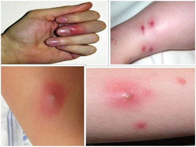 Bacterial Skin Infections: Impetigo and MRSA