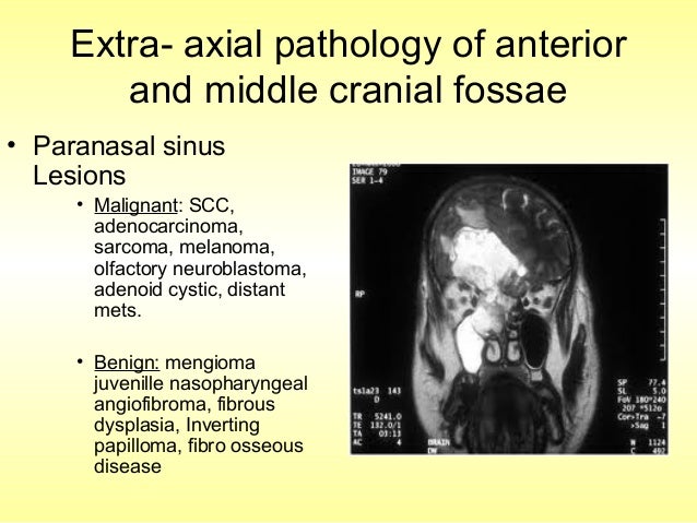 reasons of nasal warts excessive sinus pressure in face