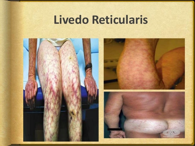Systemic Lupus Erythematosus - Case Management and Systemic Lupus Erythematosus - Case Management and