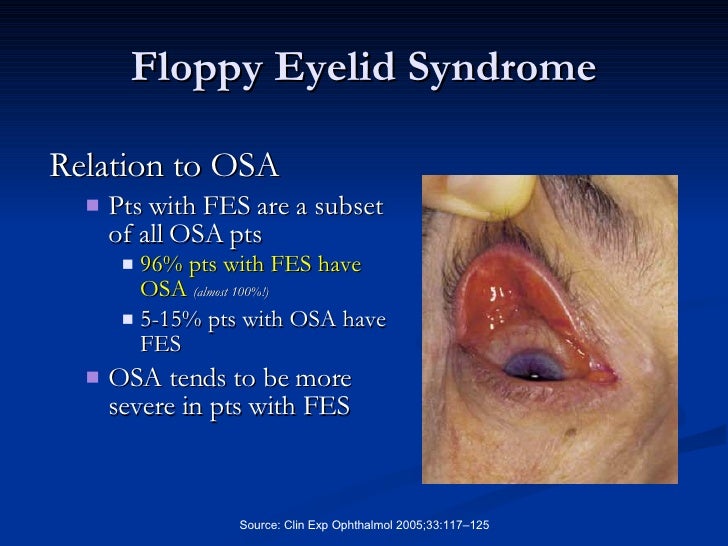 Sleep Apnea And The Eye 2008 Floppy Eyelid Syndrome