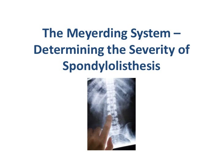 l5 listhesis Bilateral l5 spondylolysis with grade i spondylolisthesis of l5 on s1 discussion spondylolysis refers to an osseous defect within the posterior neural arch. l5 listhesis Bilateral l5 spondylolysis with grade i spondylolisthesis of l5 on s1 discussion spondylolysis refers to an osseous defect within the posterior neural arch.