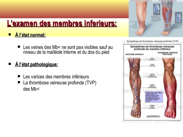 La varice variqueuse les premiers signes et le traitement