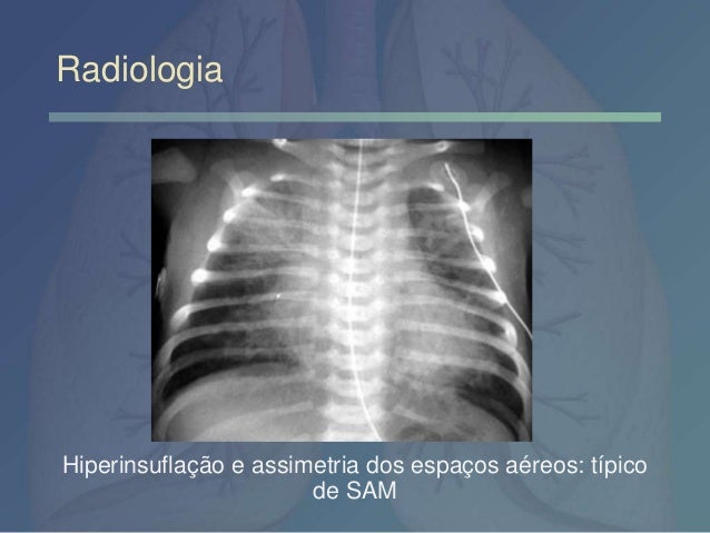 Síndrome Aspiração meconial