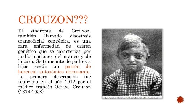 Pedofilia, rituales, y pactos de silencio: los secretos que la élite no quiere que sepas - Página 3 Sndrome-de-crouzon-2-638