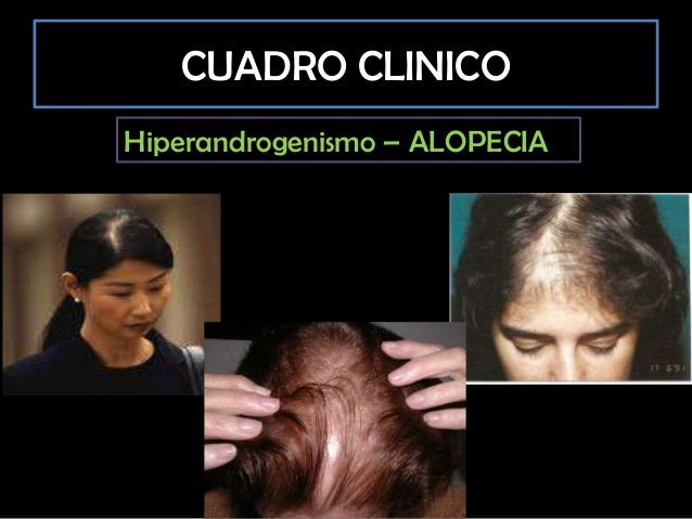 Síndrome de ovario poliquístico Síndrome de ovario poliquístico