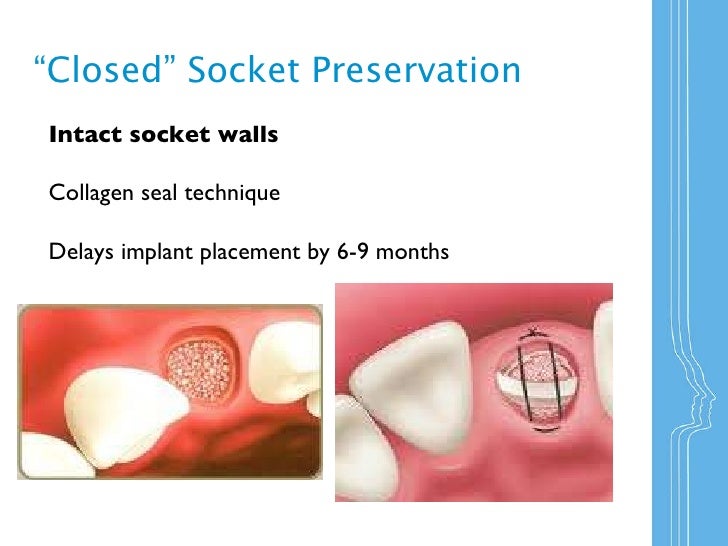 Socket Preservation _NIDM January 2011