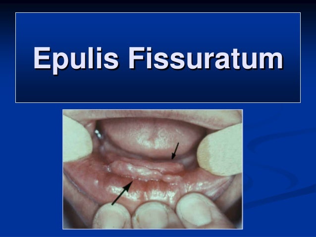 Epulis fissuratum - MediGoo - Health Tests and Free ...