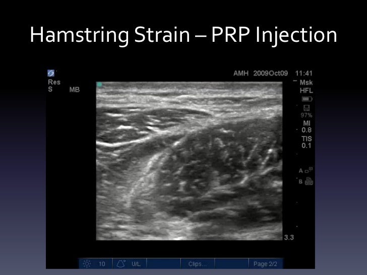 Ultrasound Guided Injections Lower Extremity