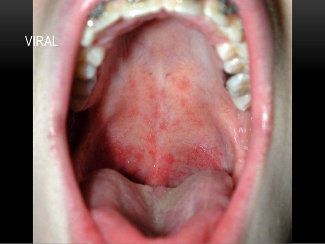 Strep Throat Viral 5
