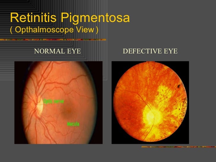 Pigmentosa Retinitis Viagra