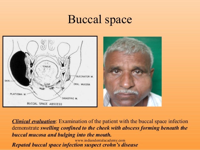 Levofloxacin in acute maxillary sinusitis holistic treatment for sinus headache