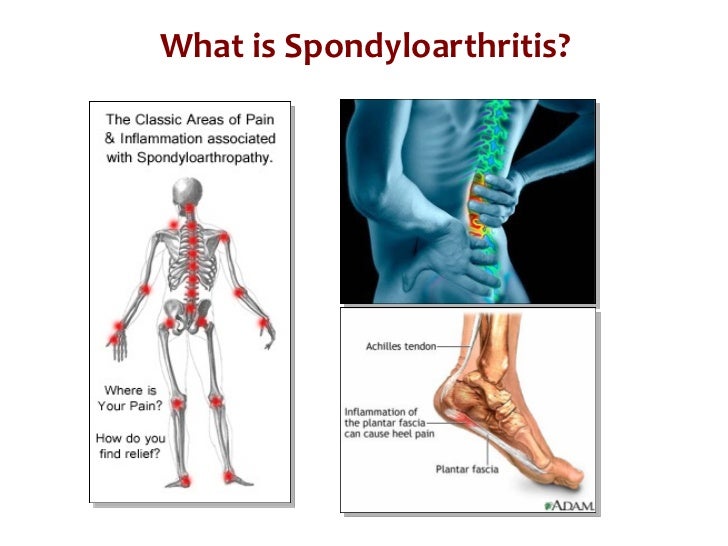 What is Spondyloarthritis? What is Psoriatic Arthritis?