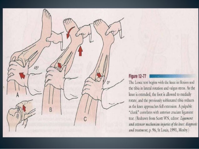 Untreated acl tear symptoms acl tear grade 2