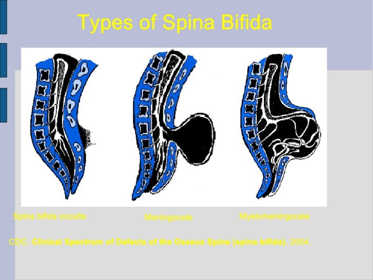 Spina Bifida And Open Neural Tube Defects