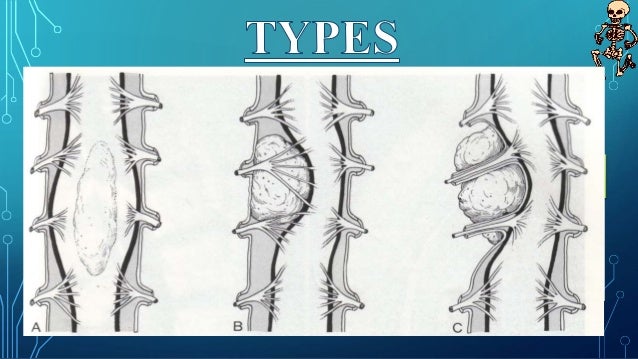 Cancer Cervical Slideshare