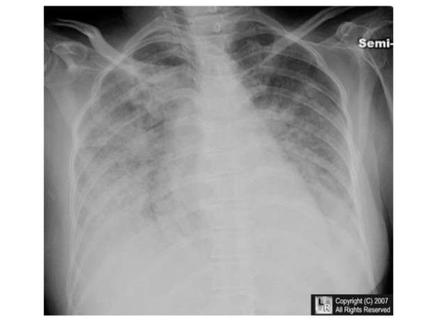 malignant mesothelioma pathology outlines