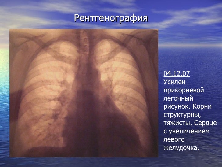 Легочный рисунок усилен в медиобазальной зоне Легочный рисунок усилен в медиобазальной зоне