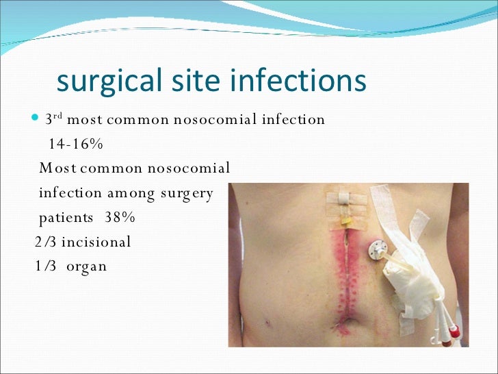 Incision Infections - Doctor insights on HealthTap