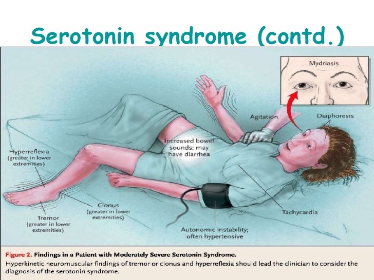 Fluoxetine Paroxetine Sertraline Citalopram Fluvoxamine