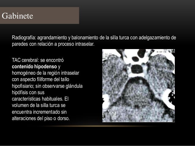 silla turca sindrome de la silla turca vacia empty sella syndrome silla turca sindrome de la silla turca vacia empty sella syndrome