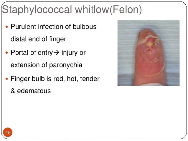 Streptococcal Infections (invasive group A strep, GAS)
