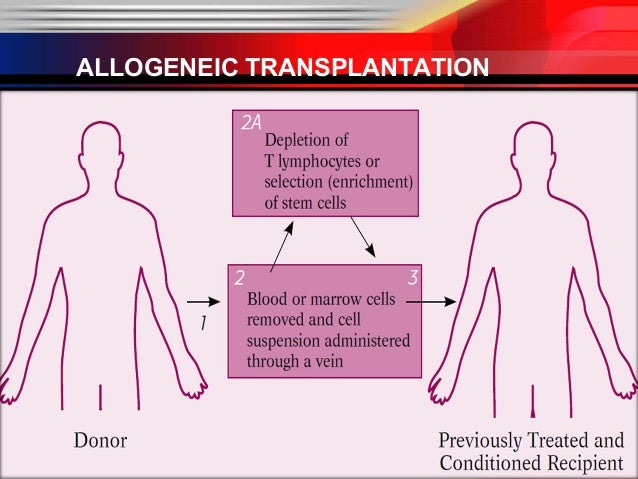 allogeneic stem cell transplant allogeneic stem cell transplant