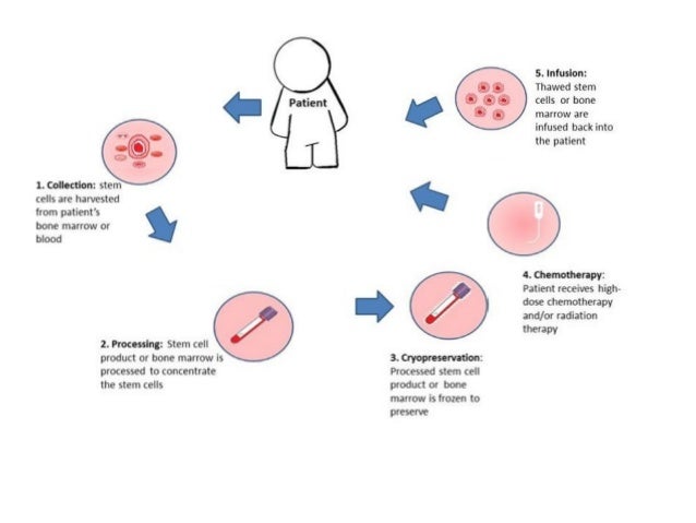 What Is Autologous Stem Cell Transplantation photo What Is Autologous Stem Cell Transplantation picture