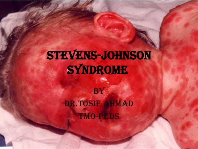 steven johnson syndrome early signs
