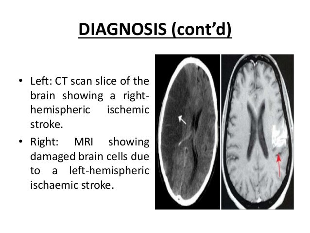 Early signs of upcoming stroke exceptional stroke care in chicago