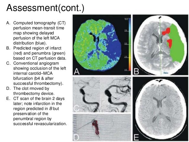ischemic stroke and seizures
