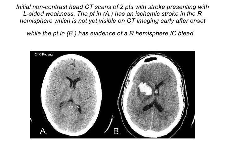 ct scan ischemic and hemorrhagic stroke