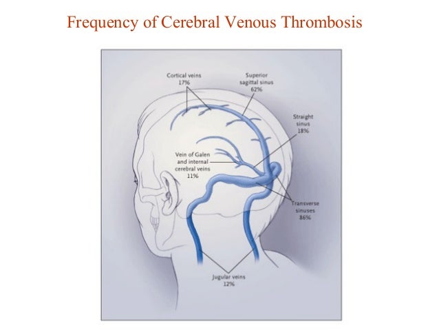 Stroke care in sanatorium stroke signs and symptoms dilated student