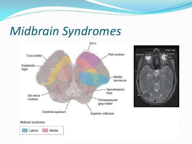 diagnosing a mini stroke signs what are the warning symptoms of a stroke or heart attack