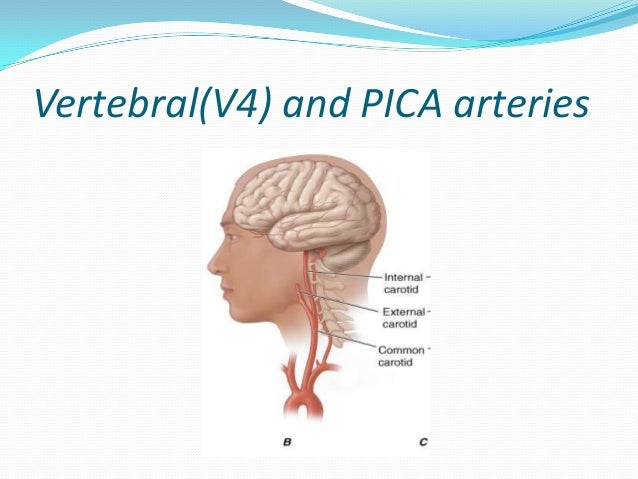 most likely source to cause pica artery infarction most likely source to cause pica artery infarction