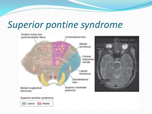 Early symptoms of stroke in girl mini stroke caution signs