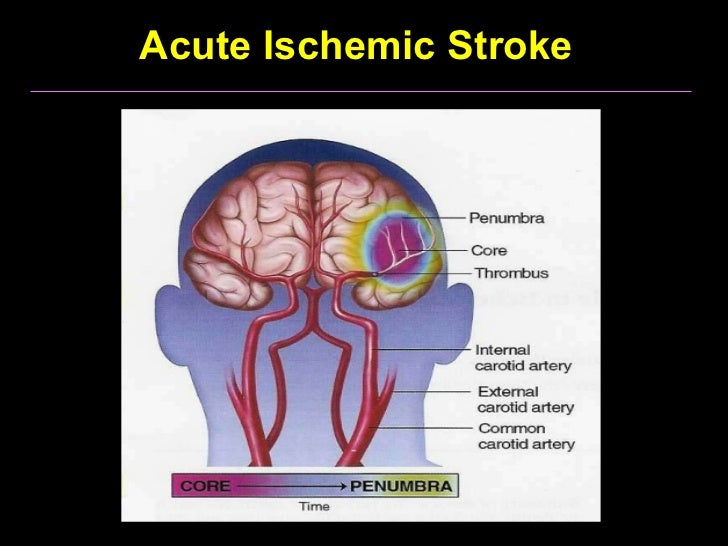 Tia stroke assist what's a stroke closing