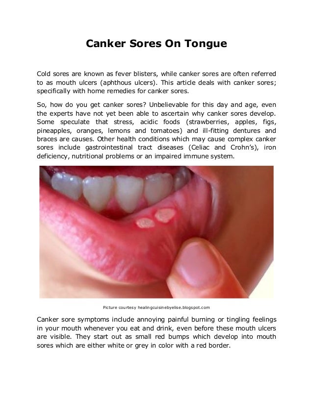 Cold Sore and Canker Sore Picture Image on MedicineNet.com
