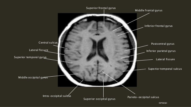 Centrum Semiovale Ct Brain Anatomy Pictures to Pin on ...